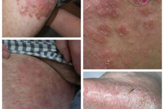 Fungal infection,Fungal infection क्या है ?,What is Fungal infection?,Fungal Infection के प्रकार,Types of Fungal Infection,फंगल इंफेक्शन होने के लक्षण,Symptoms of Fungal Infections,फंगल इंफेक्शन से कैसे बचा जा सकता है ? | How can Fungal Infection be Prevented?,फंगल इंफेक्शन होने के कारण,due to fungal infection,फंगल इंफेक्शन होने पर डॉक्टर से इलाज कब करवाएं?,फंगल इंफेक्शन हो गया है क्या करूँ ?,skin specialist,मेरे शरीर के अंधुनि जगह पर लाल धब्बे हो रहे है क्या करूँ ?,Fungal infection क्या है ? और इसको कैसे ठीक करें?,फंगल इंफेक्शन,फंगल इंफेक्शन कैसे होता है?,फंगल इंफेक्शन हिंदी में,फंगल इंफेक्शन के लक्षण,फंगल इंफेक्शन की दवा,फंगल इंफेक्शन क्रीम,फंगल इंफेक्शन क्यों होता है,फंगल इंफेक्शन का इलाज,फंगल इंफेक्शन कैसे होता है,fungal infection cream,fungal infection treatment,fungal infection on face,fungal infection tablet,fungal infection on scalp,fungal infection in ear,fungal infection medicine,fungal infection kya hota hai,fungal infection kaise hota hai,fungal infection kya hai,fungal infection kyu hota hai,fungal infection ki dava,fungal infection ka ilaj,fungal infection ke lakshan,fungal infection ki dawai,fungal infection kya hota hai,fungal infection kya hai,fungal infection kya hota h,fungal infection kya nahi khana chahiye,fungal infection kya hota hai hindi mein,fungal infection kya hota h in hindi,fungal infection kaise होता,fungal infection kya khana chahiye,anjana,anjanahub.com,anjanahub, www.anjanahub.com,